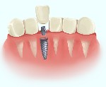 Дантисты, стоматологи объявление но. 3054708: Имплантация под ключ