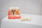 Дантисты, стоматологи объявление но. 1058915: Уникальная акция на установку имплантатов мировых лидеров!