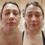 Косметика, парфюмерия объявление но. 1853619: SMAS лифтинг