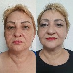 Косметика, парфюмерия объявление но. 1853619: SMAS лифтинг