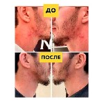 Косметика, парфюмерия объявление но. 2854093: Спрей для кожи от прыщей Silver Shein